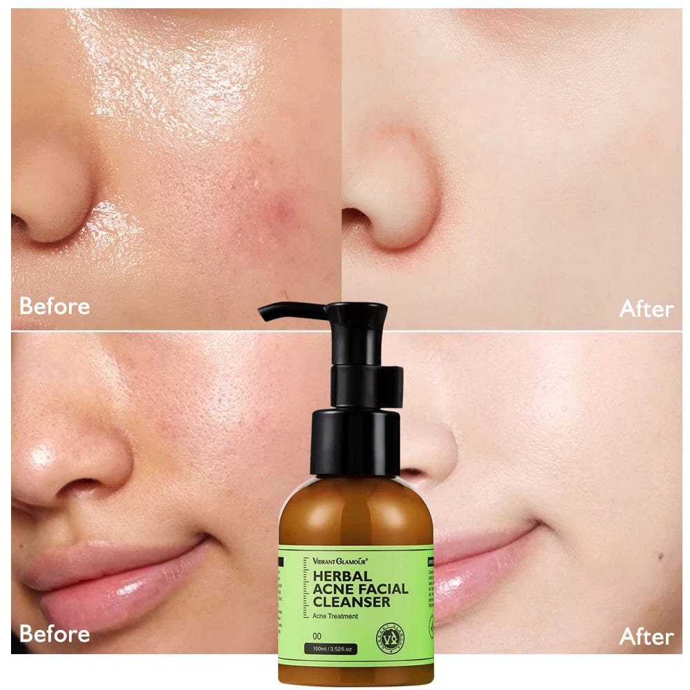 Herbal Acne Facial Cleanser